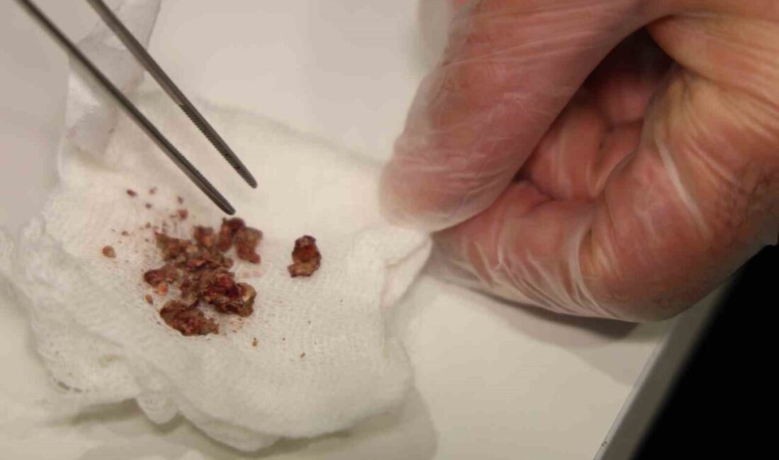 Elazığ’da burun estetiği için ameliyata alınan bir hastanın burnunda taş