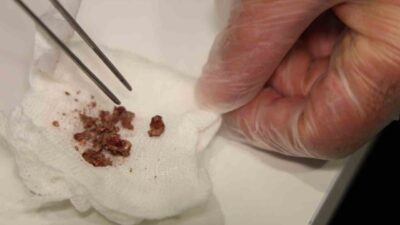 Elazığ’da burun estetiği için ameliyata alınan bir hastanın burnunda taş