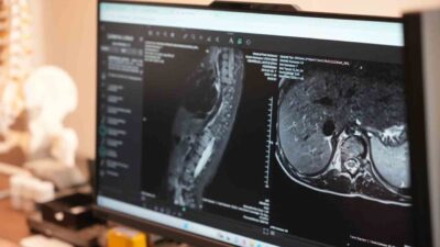 Omurganın yana doğru eğilmesiyle ortaya çıkan skolyoz, özellikle çocukluk ve