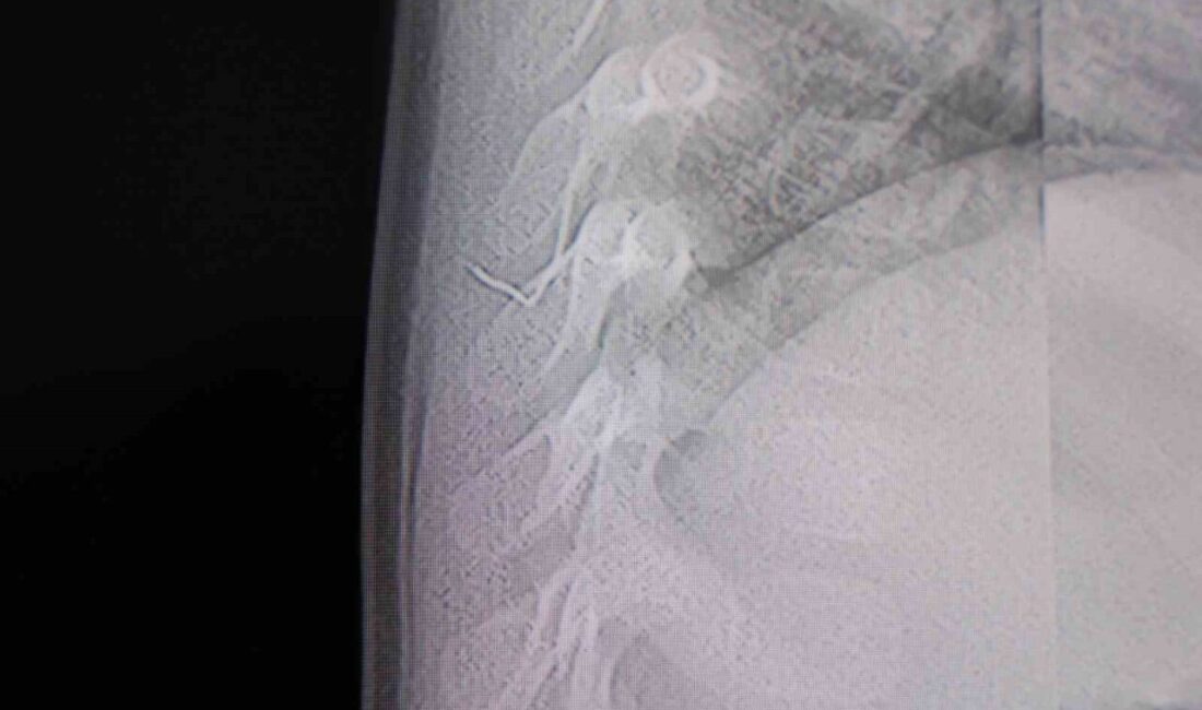 Kahramanmaraş’ta sırt üstü yatmak istemeyen, yatırıldığında ağlama ve huzursuzluğu nedeniyle