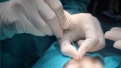 Hakkari’nin Çukurca Devlet Hastanesi’nde göz hastalıkları alanında ileri düzey tedavi