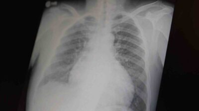 Göğüs Hastalıkları Uzm. Prof. Dr. Şevket Özkaya, tüm dünyada çocuk