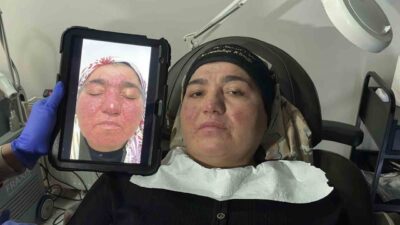 Gül hastalığı yüzünden sosyal hayattan kopan ve yıllarca evden çıkamayan