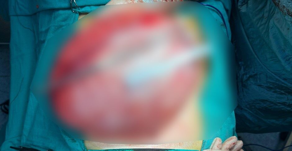 Bolu’da fazla kilolarından kurtulmak amacıyla hastaneye başvuran 14 yaşındaki lise